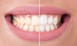 teeth bleaching agents