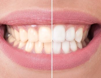 teeth bleaching agents